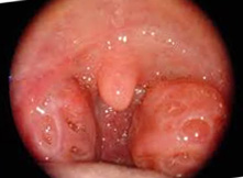 Ipertrofia tonsillare