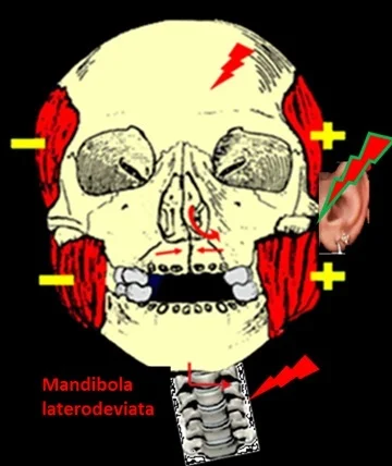 Mandibola latero deviata