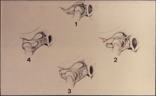 Menisco sublussato mesialmente (posizione 1), Nell’apertura della bocca, l’avanzamento del condilo ricattura il menisco nella posizione 4.