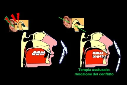 Terapia occlusale con bite per rimozione del conflitto