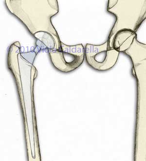 articolazione dell’anca dopo l’impianto di un’artroprotesi “classica”
