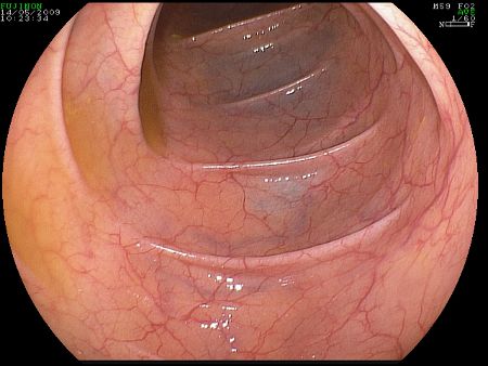 Mucosa normale del colon