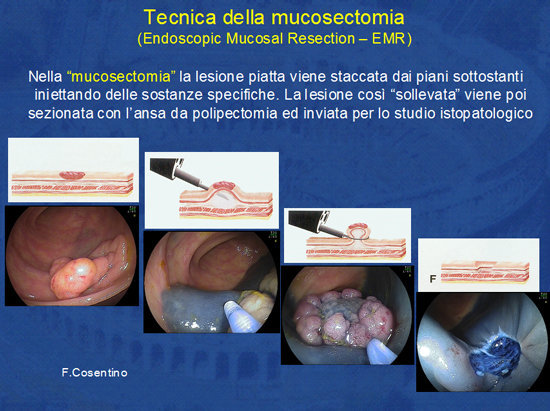 Mucosectomia