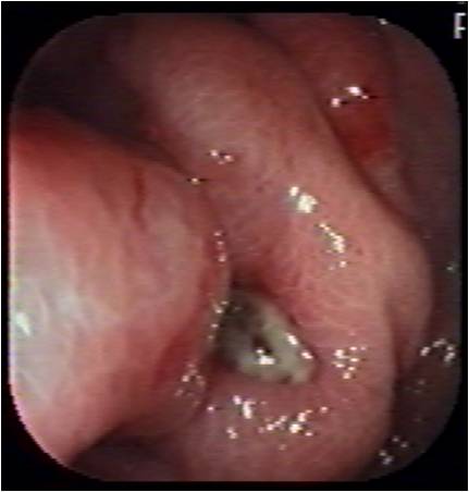 Ulcera gastrica causata dalla fuoruscita di sostanze dalle batterie nello stomaco
