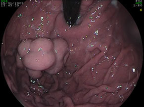 fondo gastrico con grosse varici (IGV1)