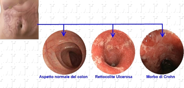 Endoscopia delle IBD