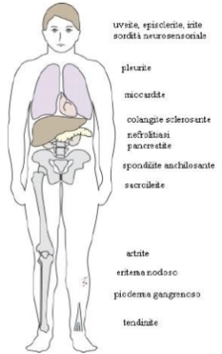 IBD - manifestazioni extraintestinali