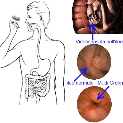 Ileoscopia con videocapsula