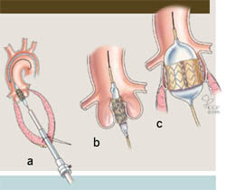 Posizionamento della protesi in aorta
