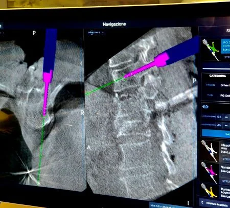 Neuronavigazione in chirurgia vertebrale