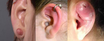 piercing orecchio cheloidi