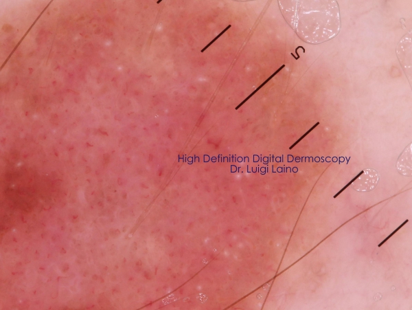Diagnosi digitale melanoma