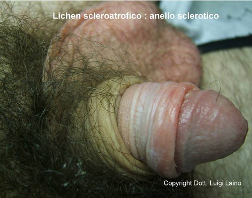 Fimosi non serrata associata a Lichen sclerosus: il prepuzio può ancora scorrere sul glande solo con pene flaccido