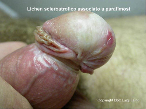 Lichen sclerosus e parafimosi