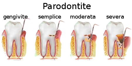 Schematizzazione della parodontite