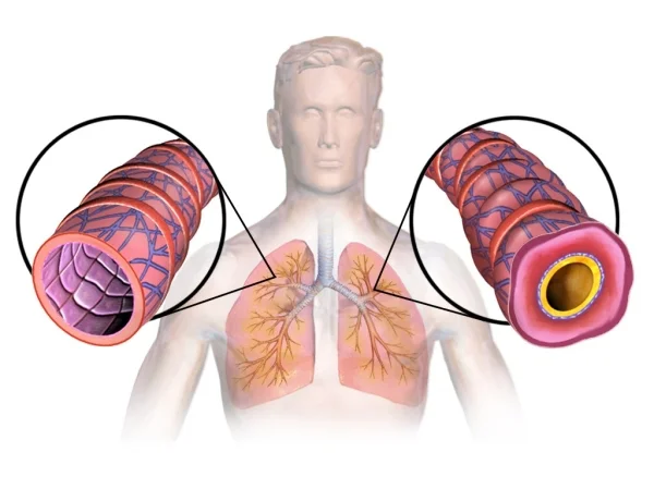 Asma: alveoli polmonari chiusi