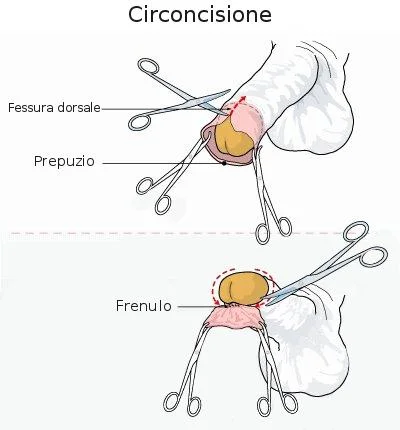 Circoncisione