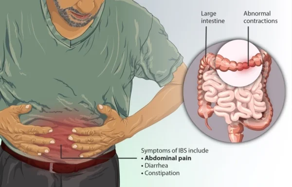 Sintomi colon irritabile