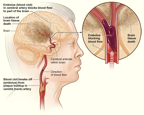 Ictus cerebrale