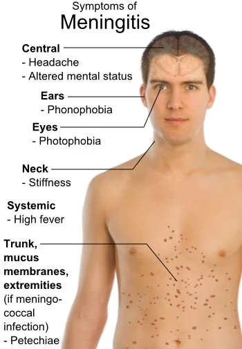 Meningite: sintomi