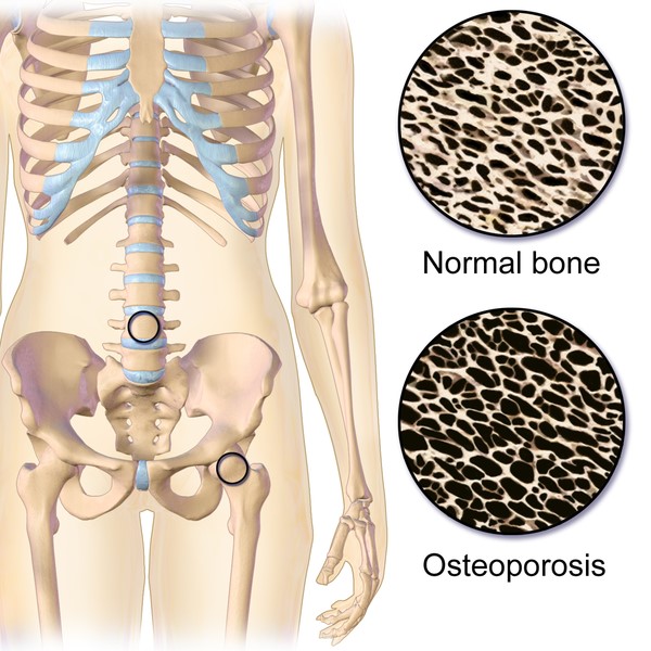 Confronto tra osso normale e osso con osteoporosi