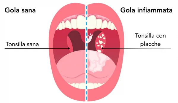 Esempio di gola sana e gola con placche