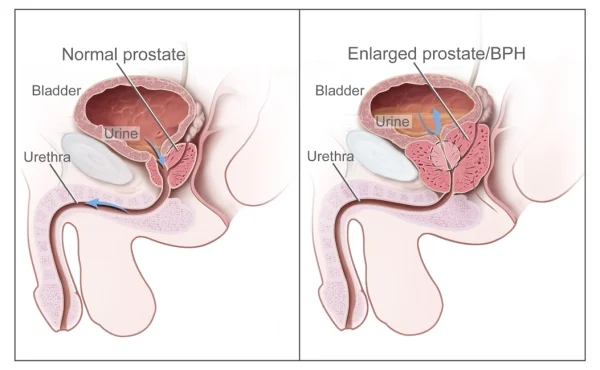 Prostata normale e prostata ingrossata 