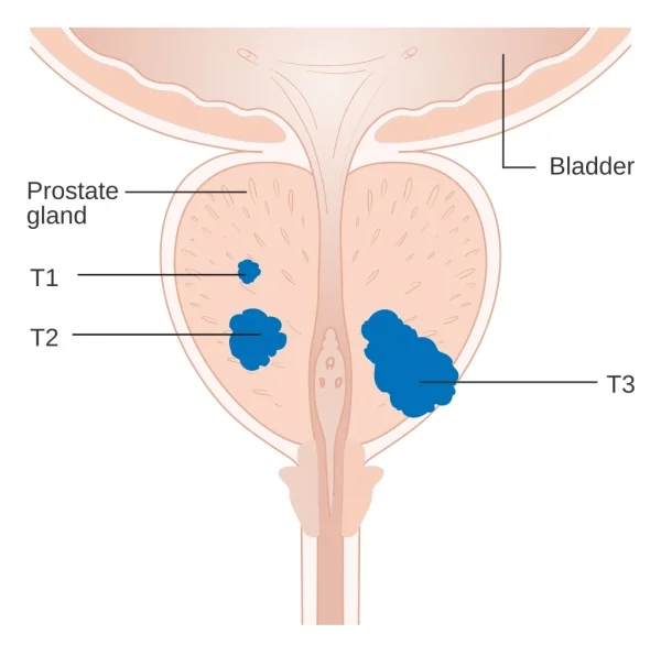 Stadiazione del tumore prostatico