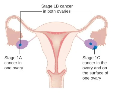 Tumore ovaio stadio 1