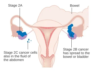 Tumore ovaio stadio 2