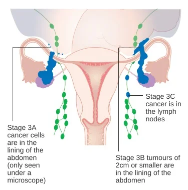 Tumore ovaio stadio 3