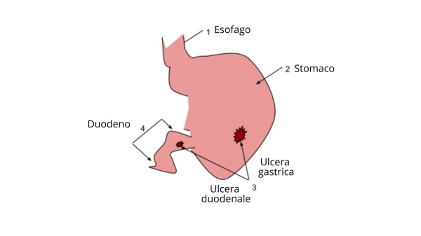 Ulcera duodenale e ulcera gastrica